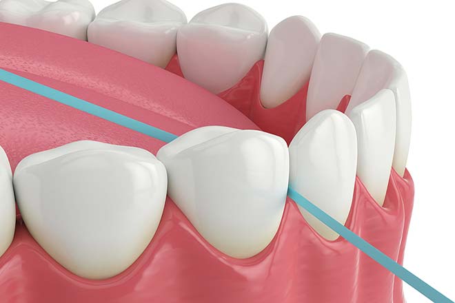 periodontal care flossing to prevent gum disease
